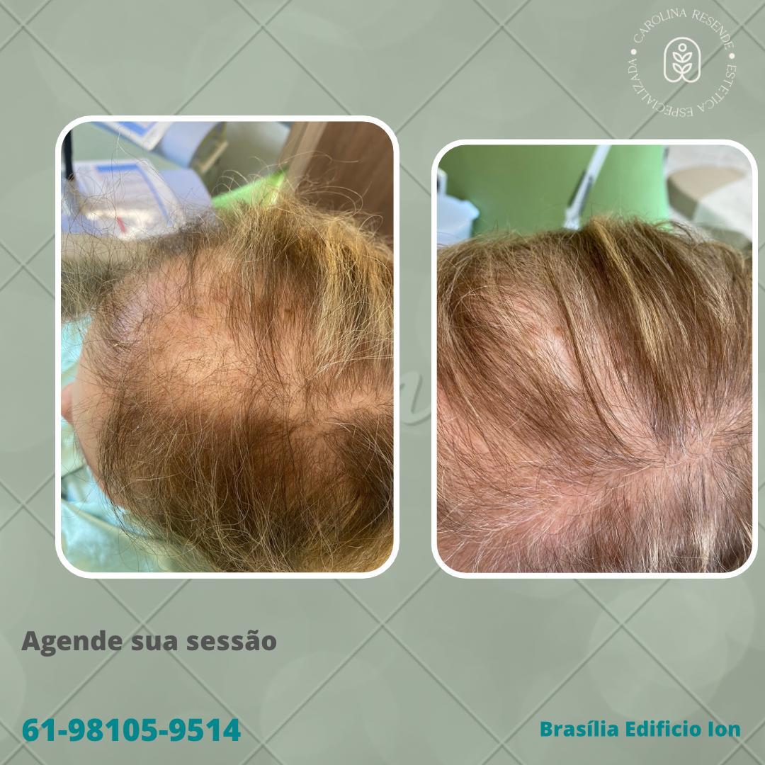 Tratamento capilar
