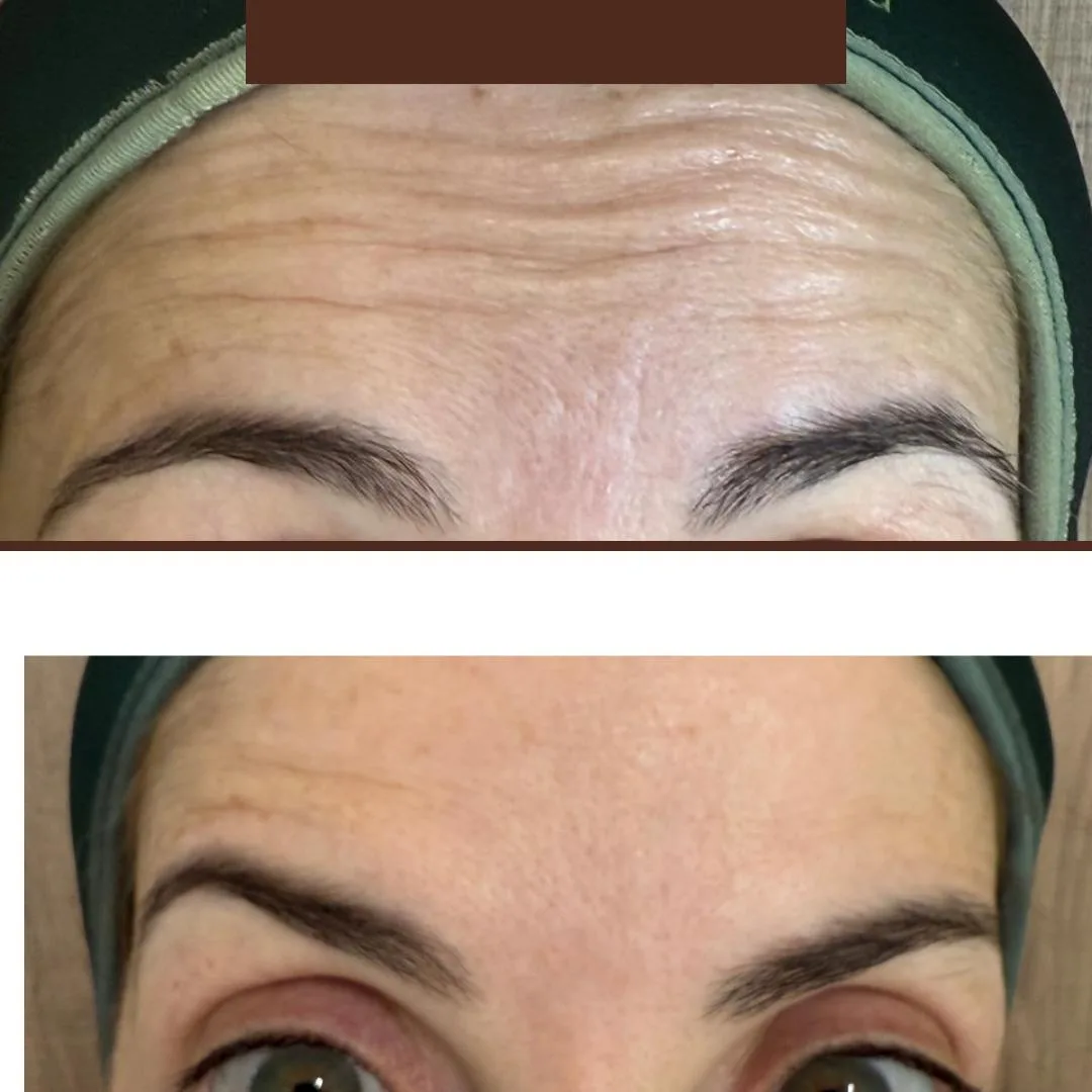 Toxina botulínica — antes e depois