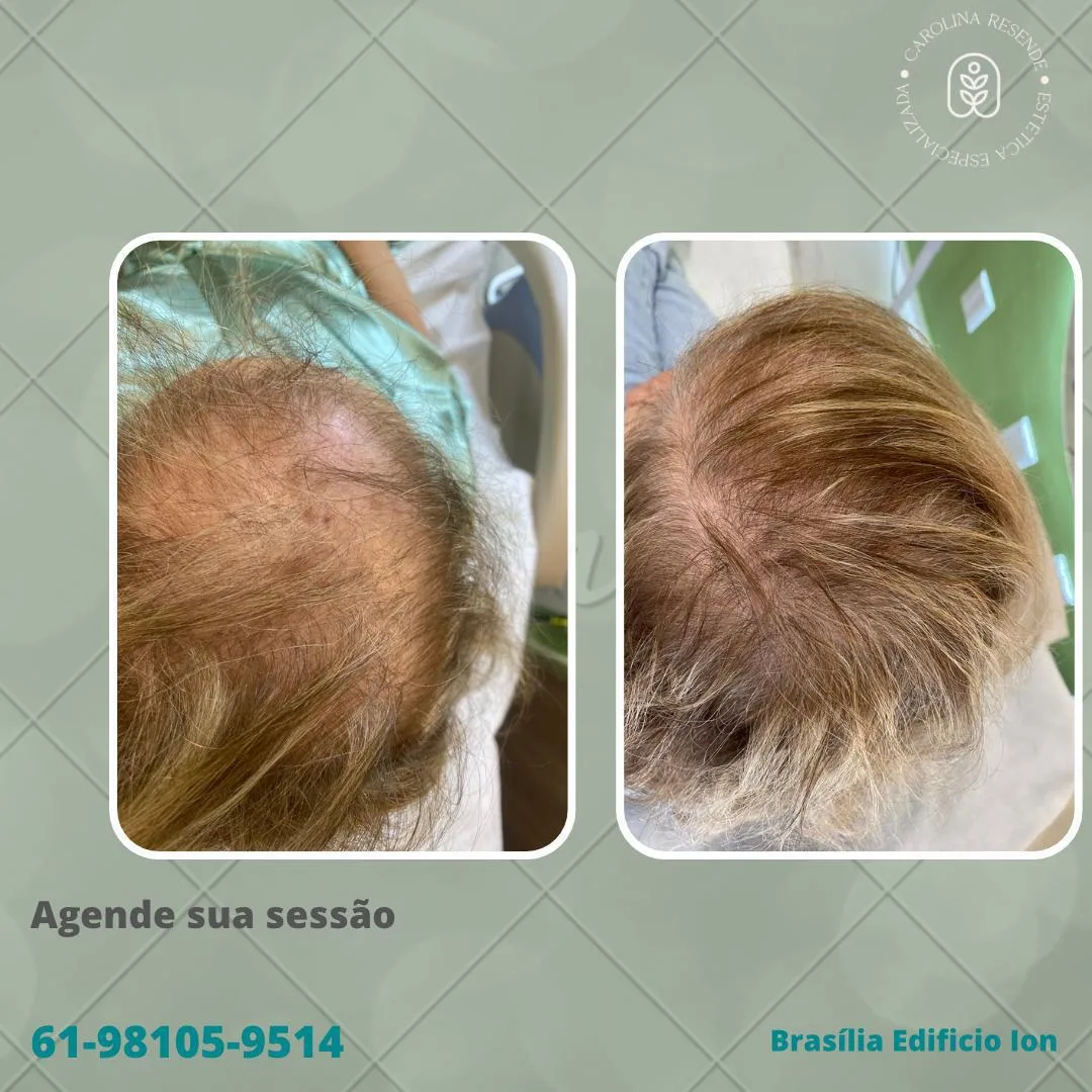 Densidade capilar — antes e depois