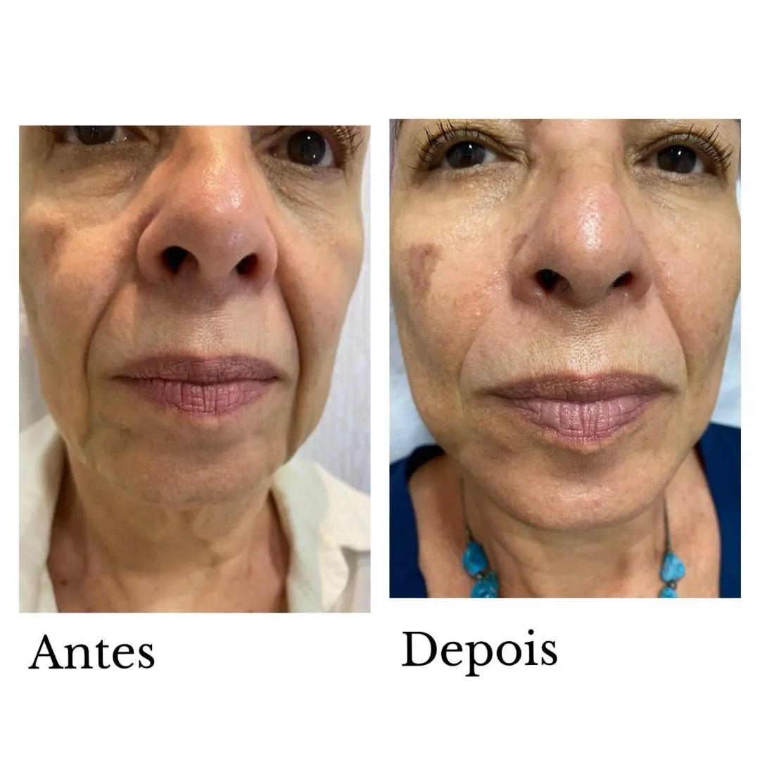Lifting facial — antes e depois