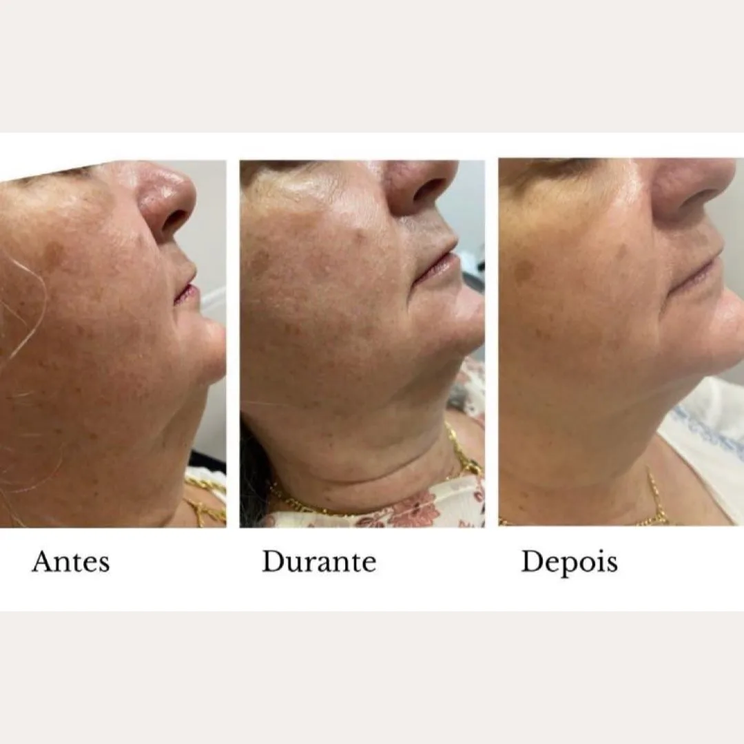 Melasma — antes e depois