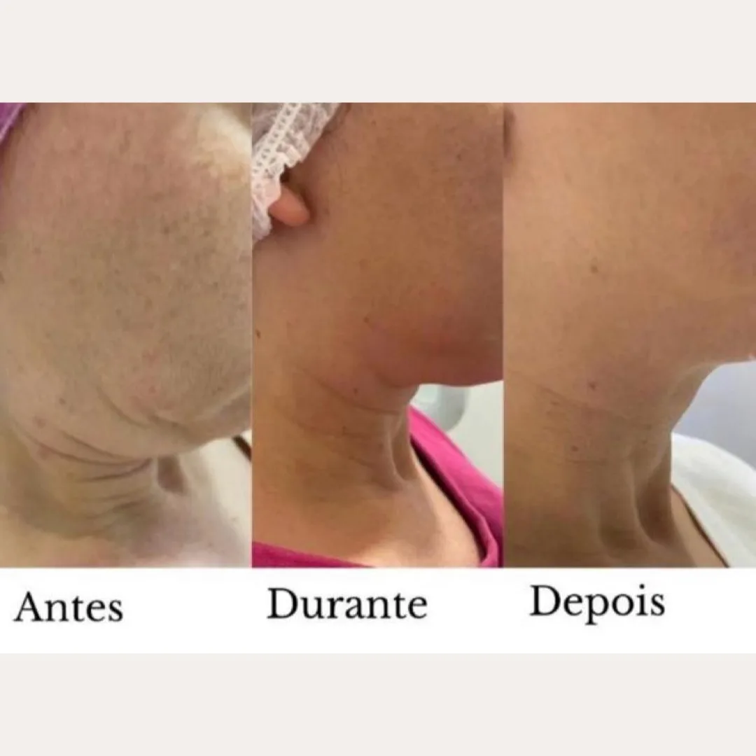 Firmeza do pescoço — antes e depois