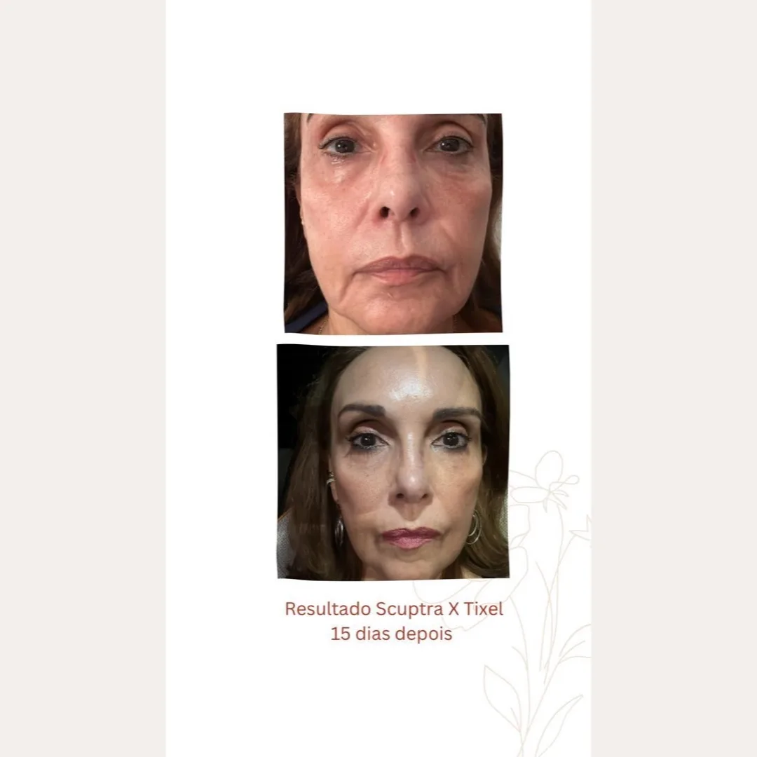 Sculptra + Tixel — antes e depois