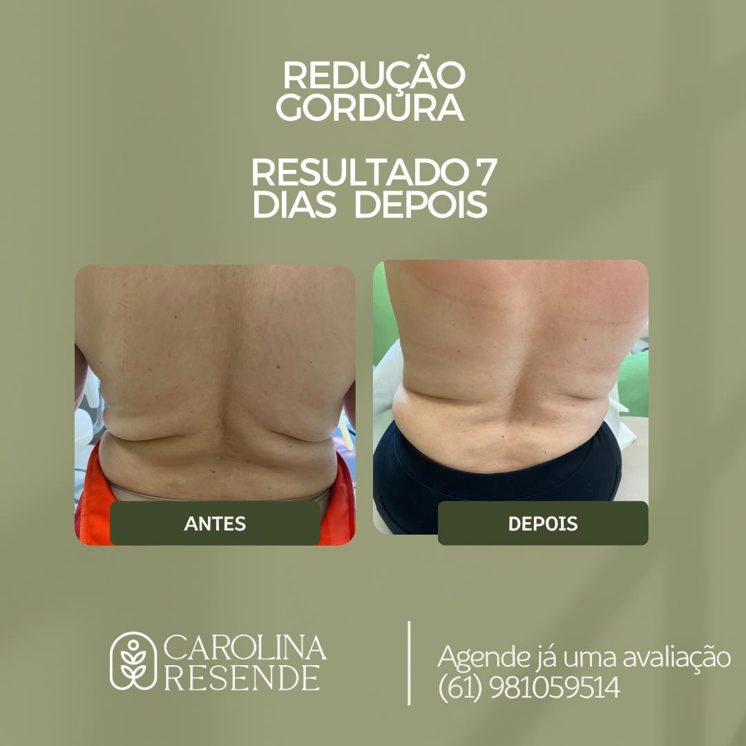 Redução de gordura lombar