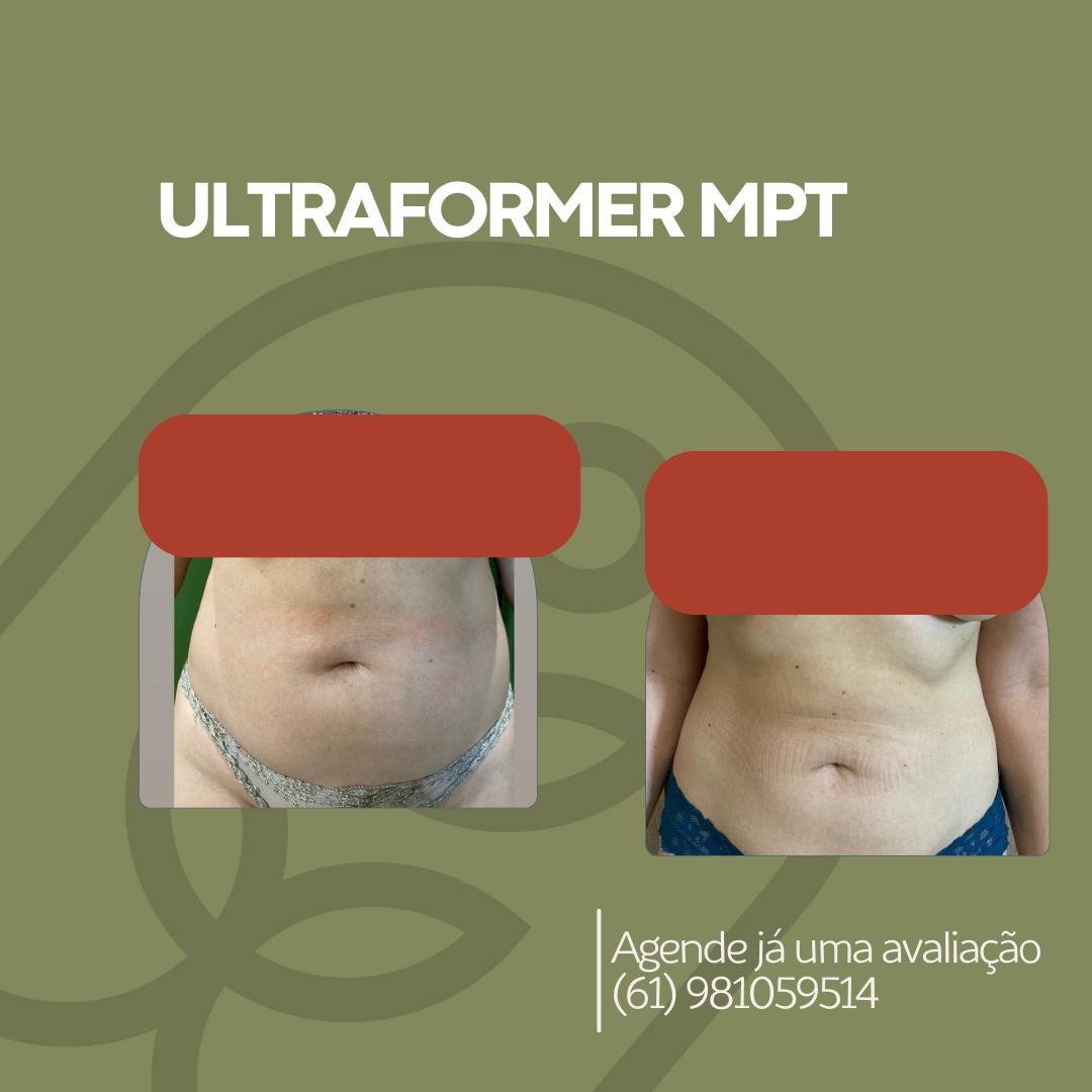 Ultraformer abdômen