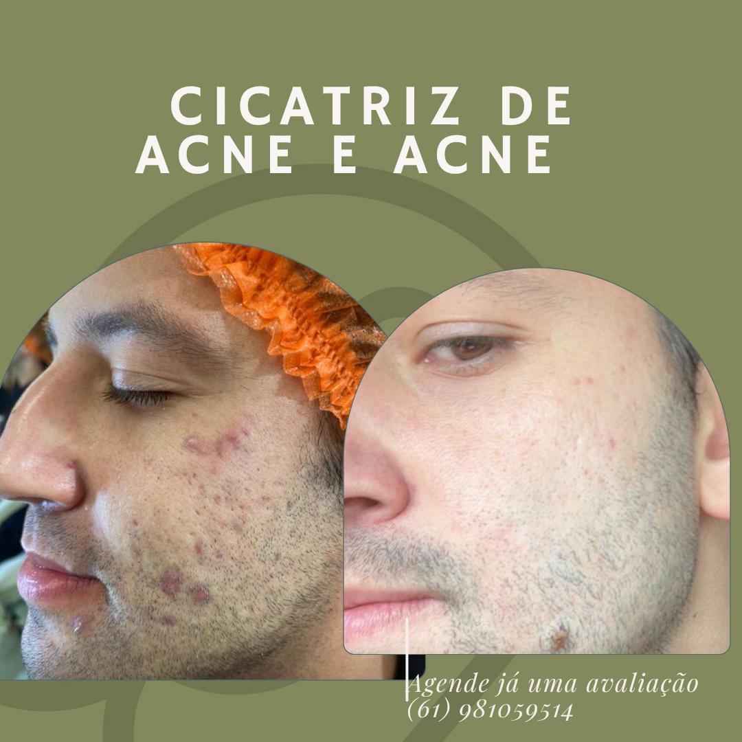 Cicatrizes de acne — antes e depois