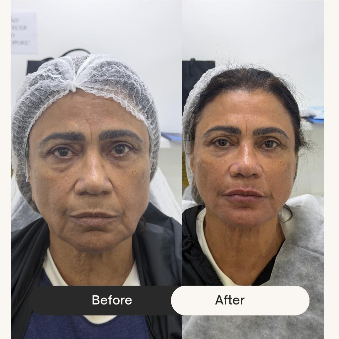 Lifting facial, antes e depois