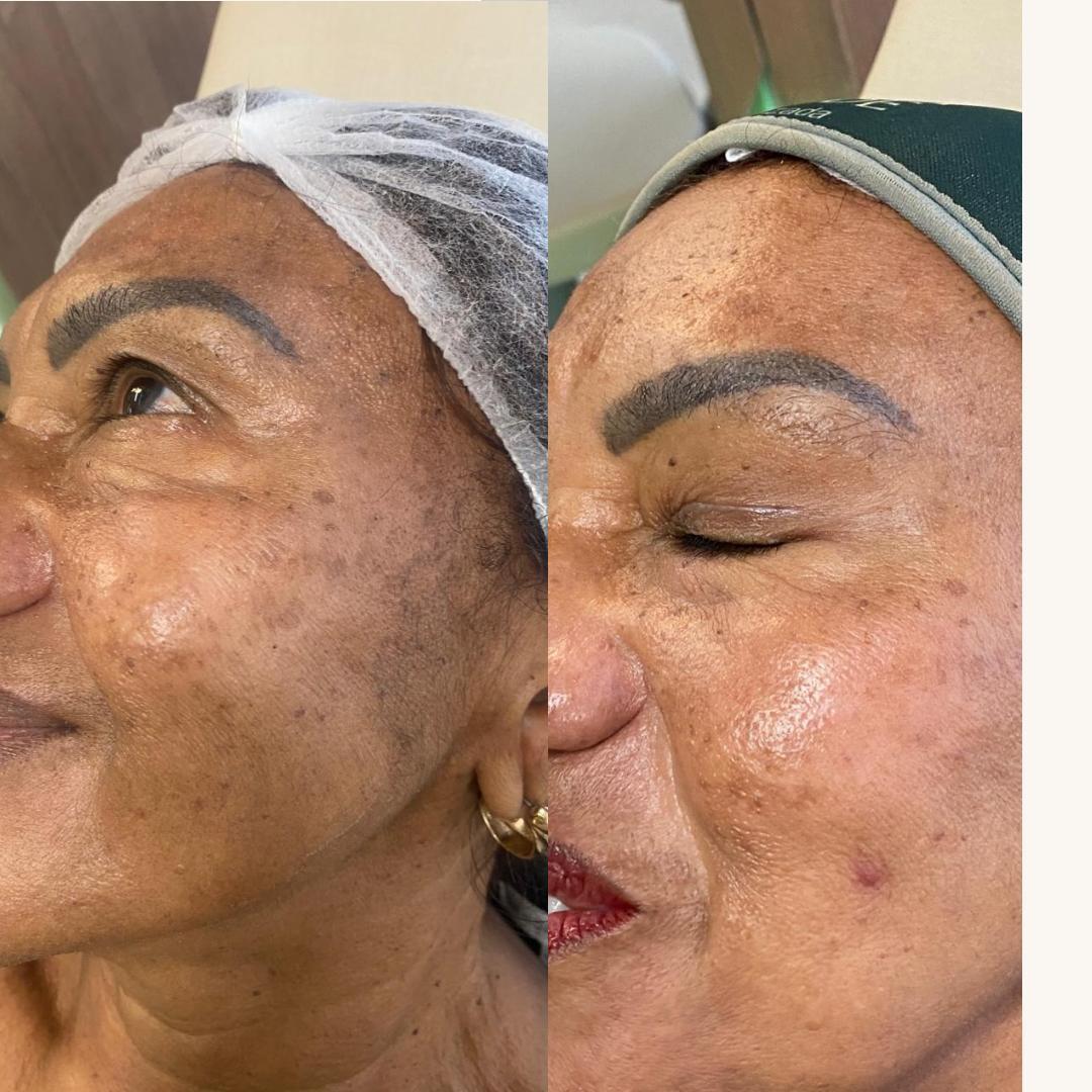 Tratamento de melasma