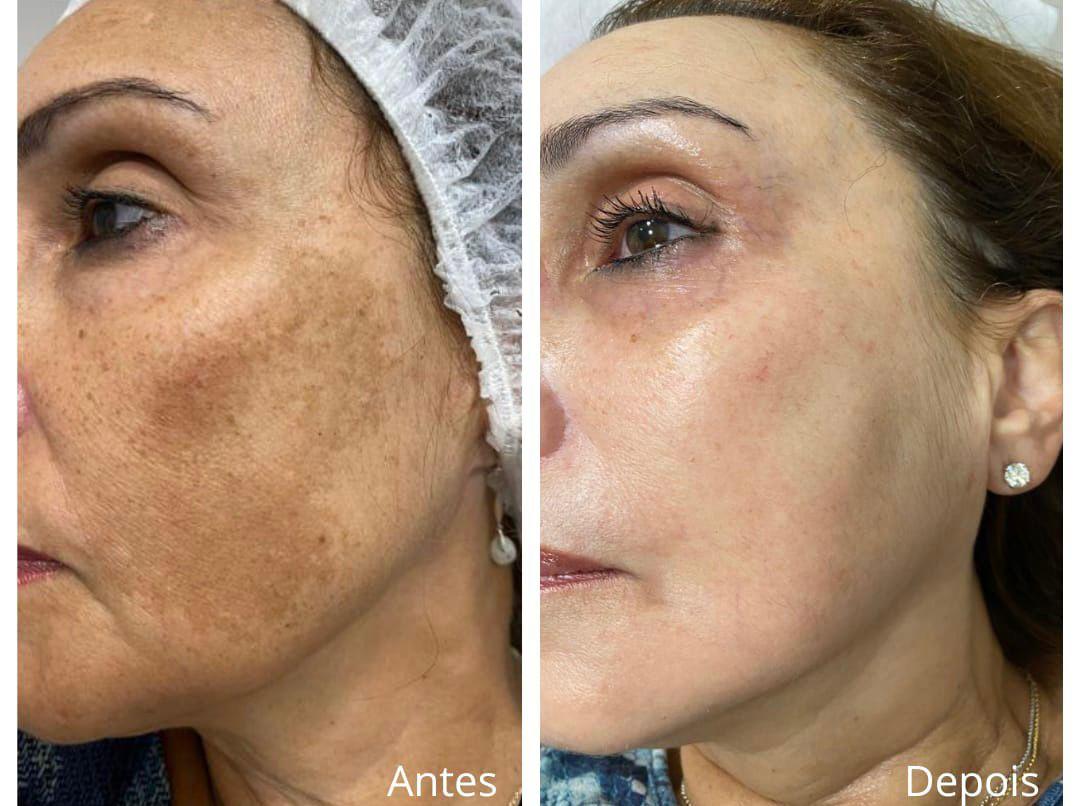 Melasma, antes e depois