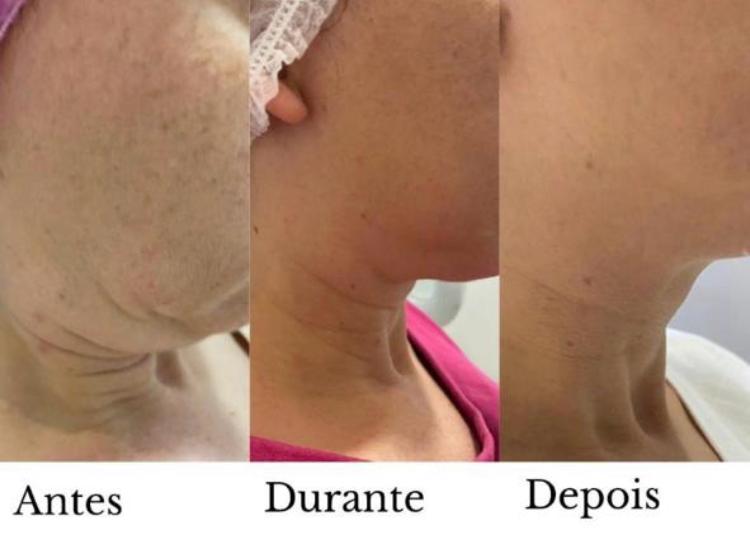 Flacidez no pescoço, antes e depois