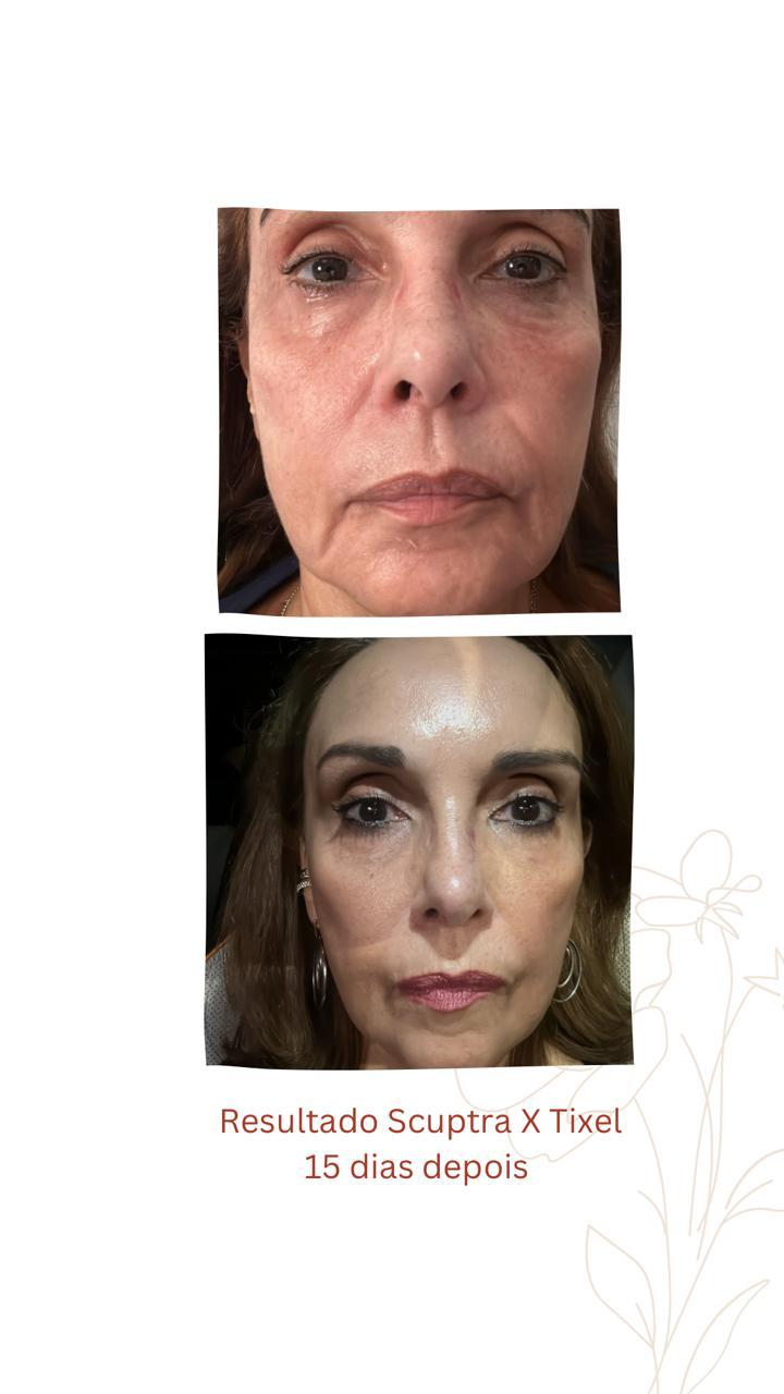 Sculptra + Tixel, antes e depois